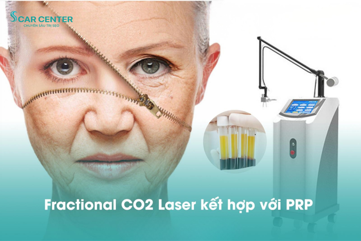 Fractional CO2 trị sẹo lõm kết hợp PRP