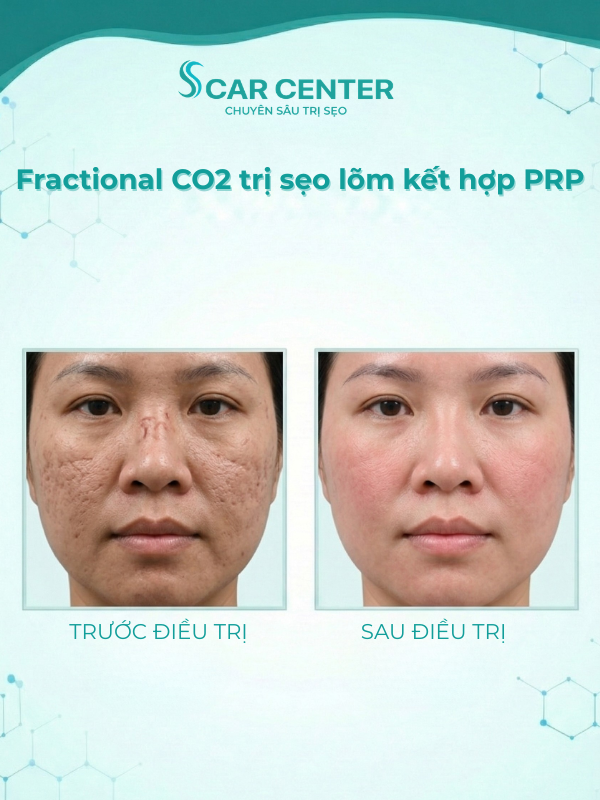 Fractional CO2 trị sẹo lõm kết hợp PRP