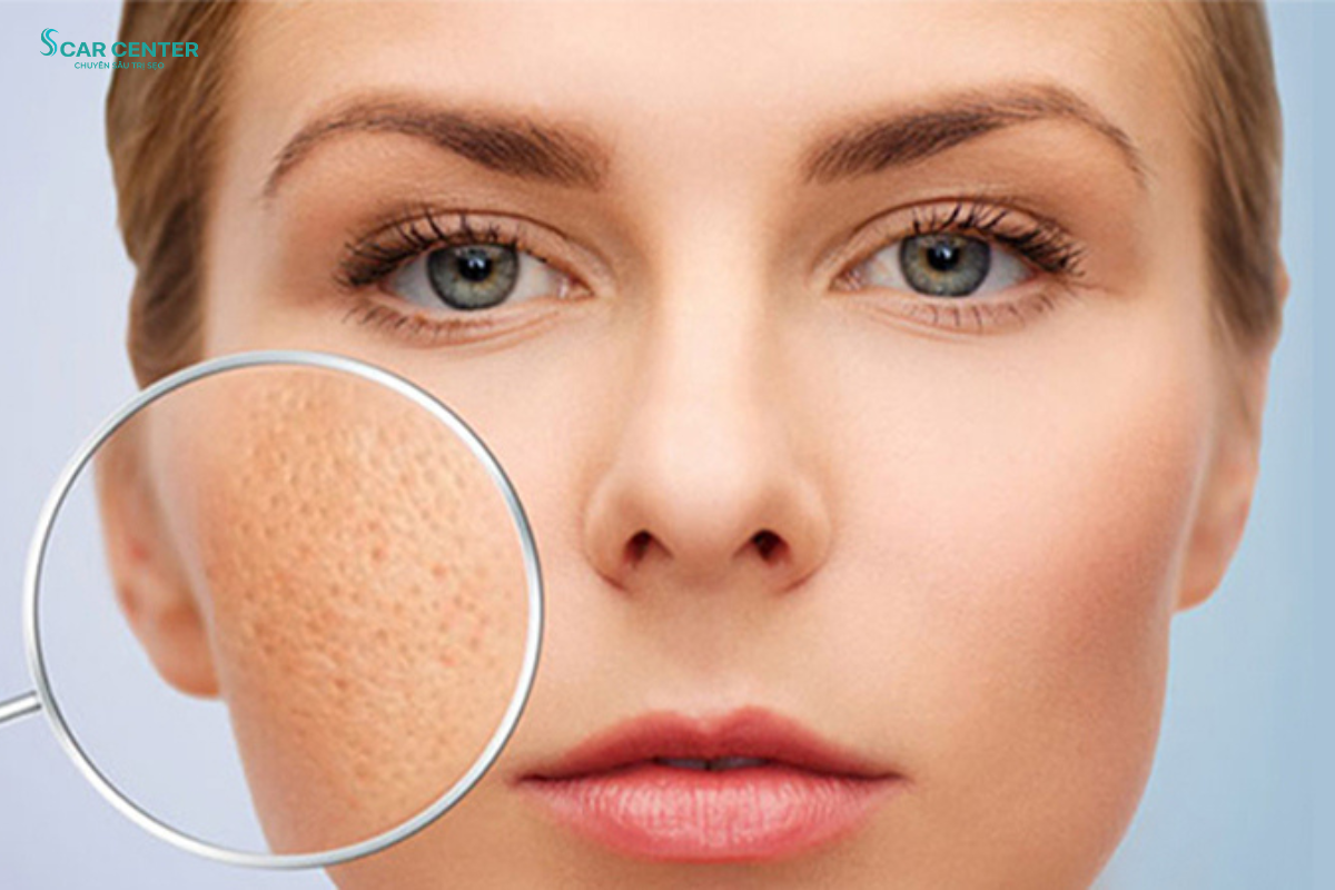 Fractional CO2 Trị Sẹo Lõm Nhẹ Tại Nhà