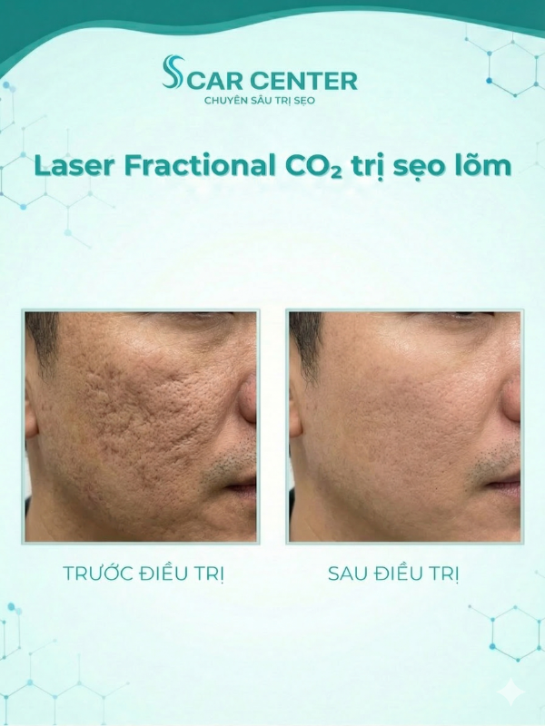 Fractional CO2 trị sẹo lõm nhẹ tại nhà
