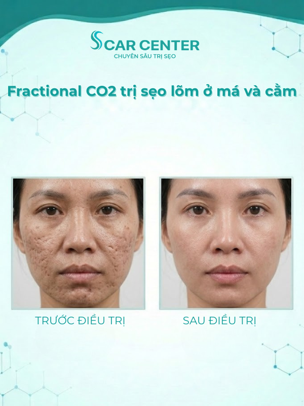 Fractional CO2 trị sẹo lõm ở má và cằm có hiệu quả không?