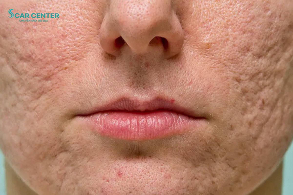 Fractional CO2 trị sẹo rỗ lâu năm có hiệu quả không