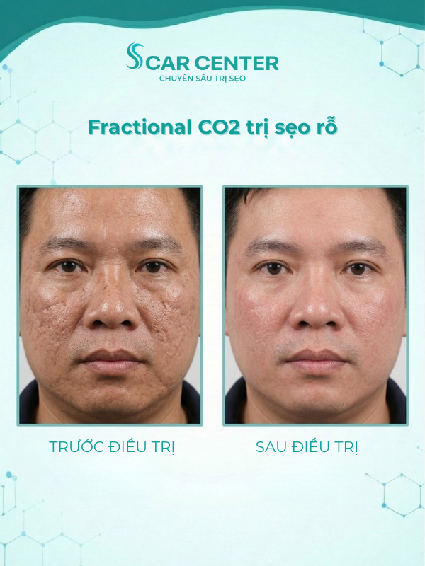Fractional CO2 trị sẹo rỗ lâu năm có hiệu quả không? Giải đáp từ bác sĩ da liễu
