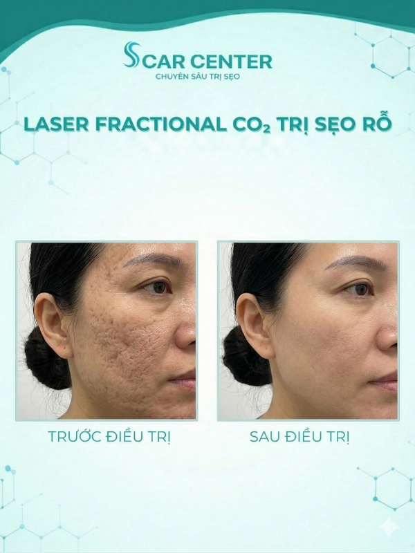 Fractional CO2 trị sẹo rỗ nặng có cần nhiều lần không?