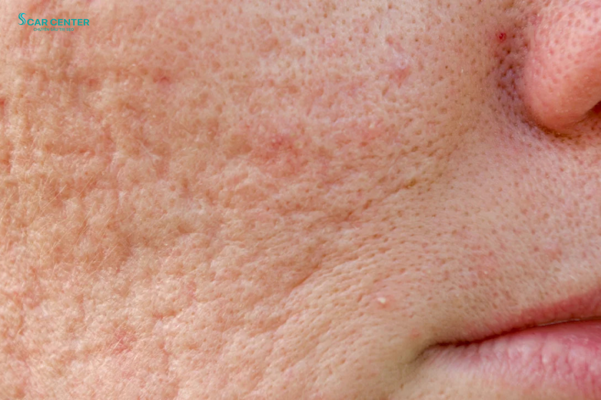 Fractional CO2 trị sẹo rỗ nặng có cần nhiều lần không