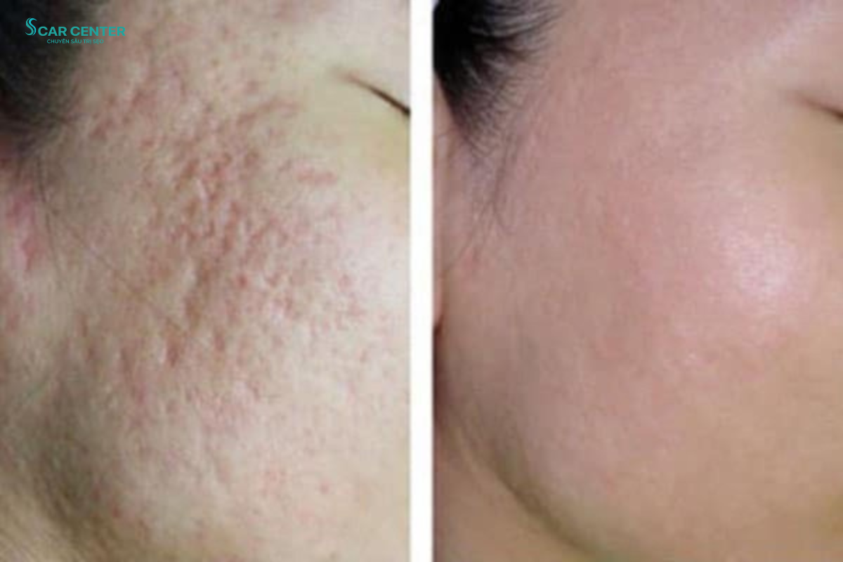 Laser Fractional CO2 trị sẹo rỗ và se khít lỗ chân lông