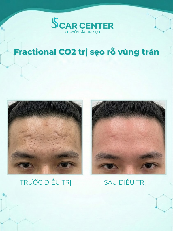 Fractional CO2 trị sẹo rỗ vùng trán có hiệu quả không?
