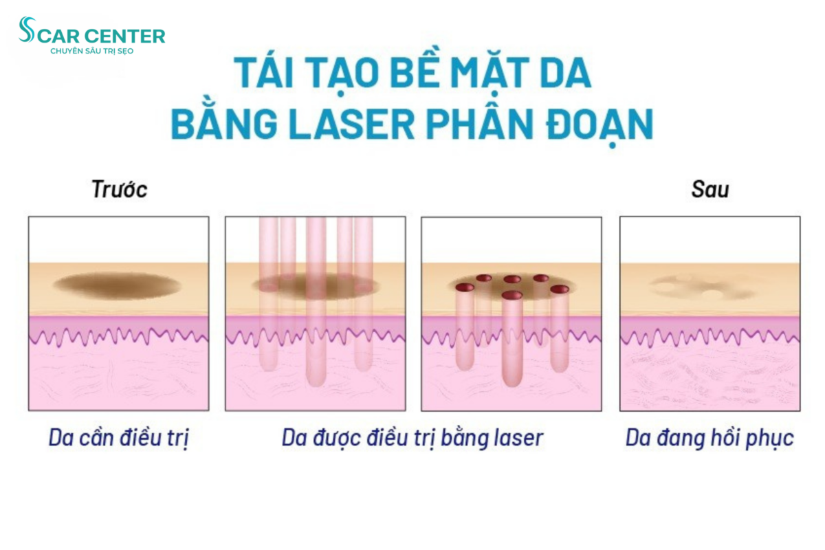 Laser Fractional CO2 trị sẹo lõm