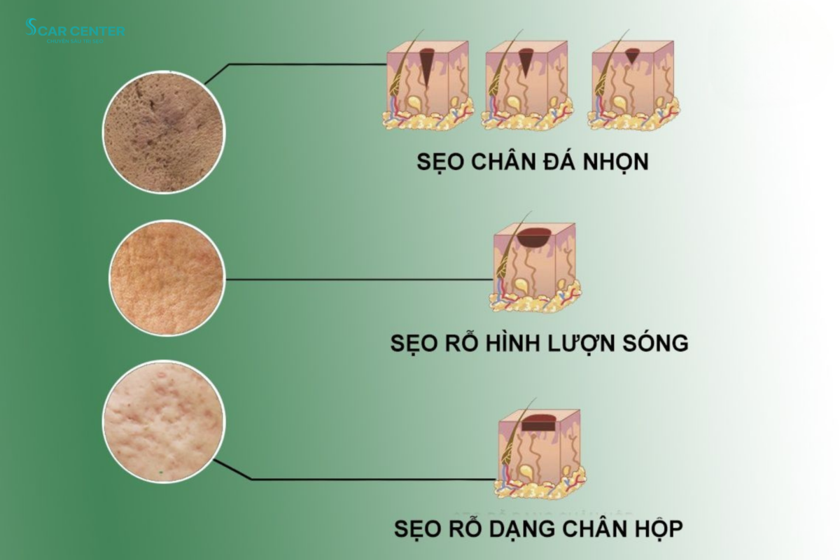 Laser Fractional CO₂ trị sẹo lõm tại TP.HCM uy tín