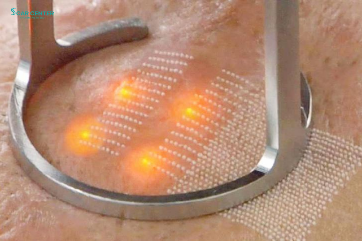 Laser Fractional CO₂ trị sẹo lõm tại TP.HCM uy tín