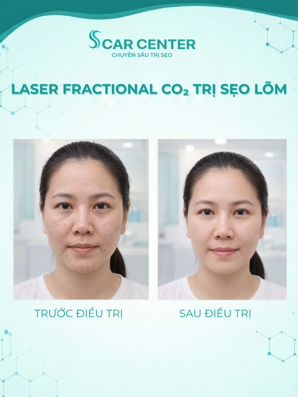 Laser Fractional CO₂ trị sẹo lõm tại TP.HCM uy tín, đâu là địa chỉ đáng tin cậy?