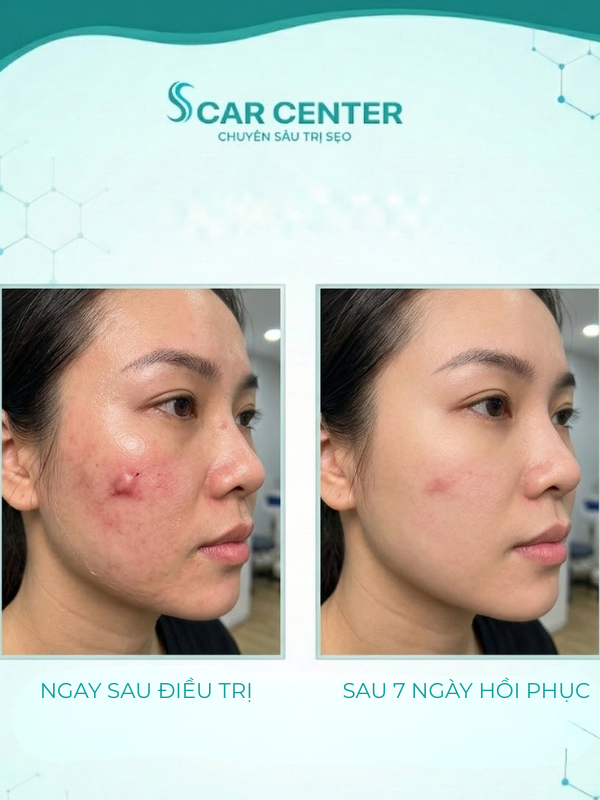 Nên trị sẹo lồi ở đâu tốt?