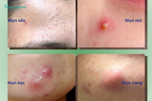 7 thói quen khiến da dễ bị sẹo sau mụn