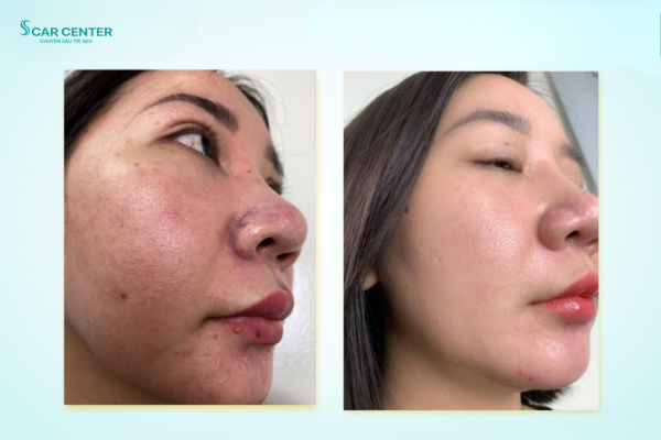 Da cải thiện 70% sau 2 lần điều trị sẹo rỗ tại Scar Center
