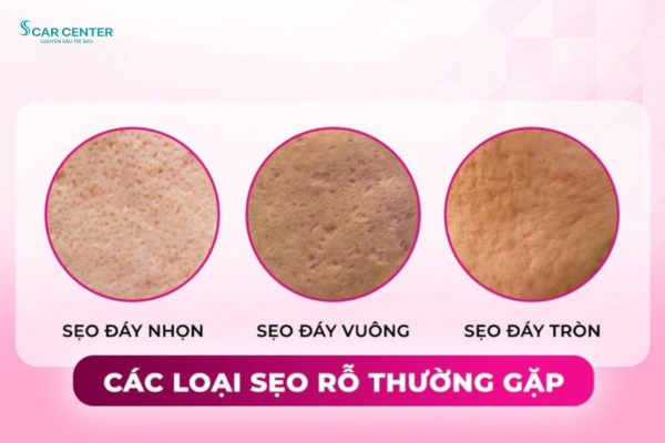 Địa chỉ điều trị sẹo rỗ uy tín tại TP.HCM