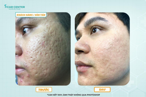 Hiệu quả điều trị sẹo rỗ