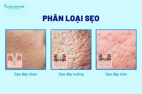 quy trình điều trị sẹo rỗ