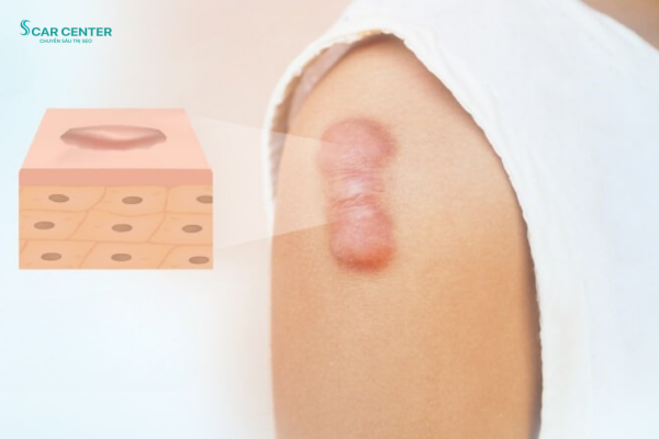 Sẹo lồi là gì? Nguyên nhân và cách điều trị đúng