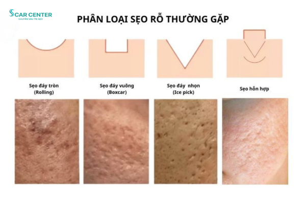 Sẹo rỗ có tự đầy không