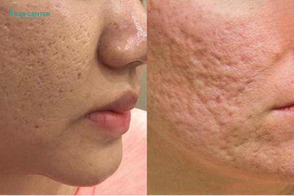 Sẹo rỗ có tự đầy không