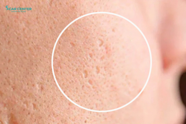 Trị sẹo rỗ ở đâu tốt nhất tại HCM