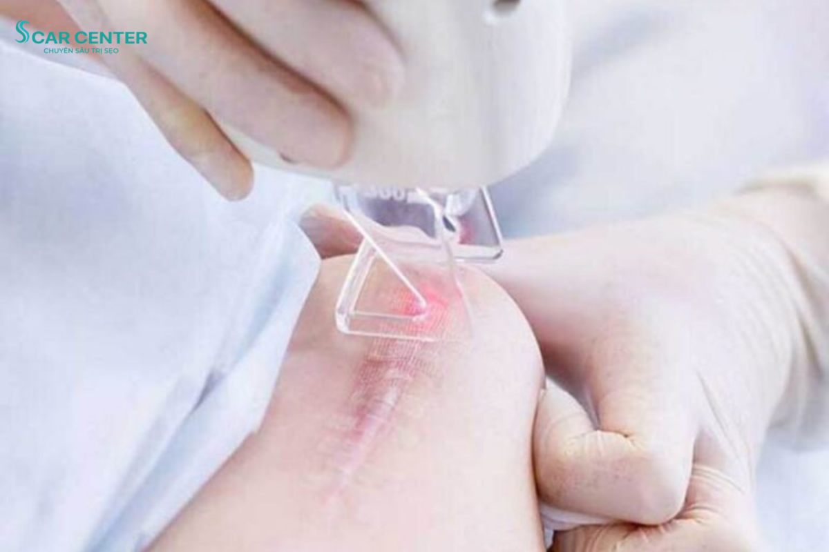 Trị sẹo lồi bao lâu thì hết?