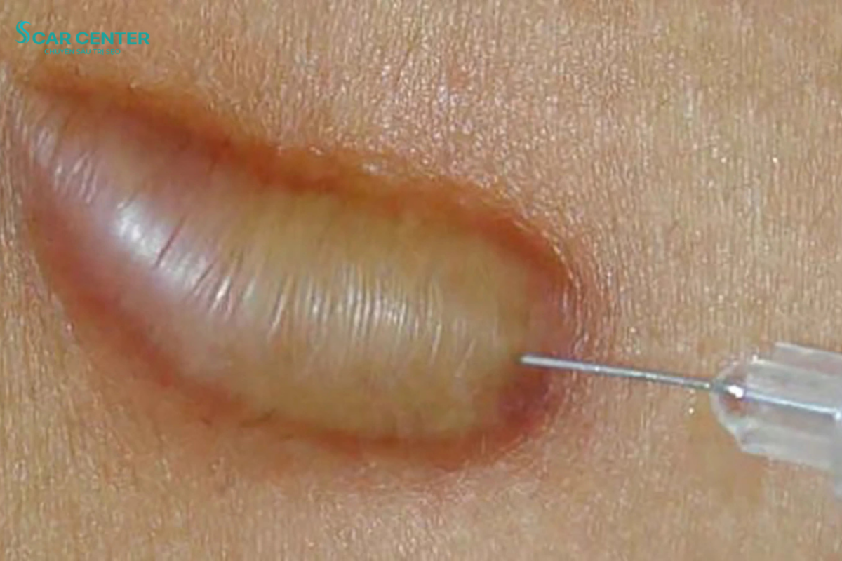 Trị sẹo lồi bao lâu thì hết?