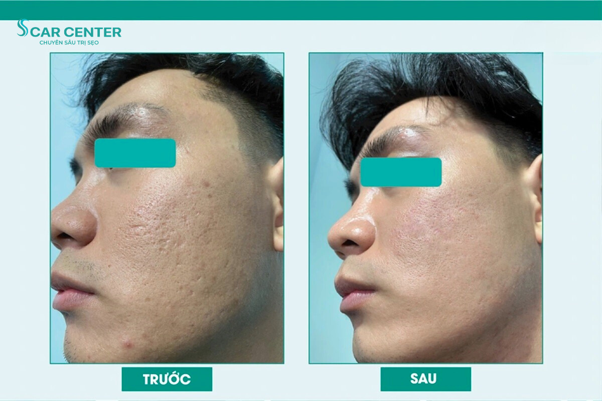 Phác đồ Premium 3in1 trị sẹo rỗ