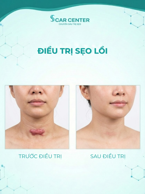 Sẹo lồi ngứa và đau do đâu