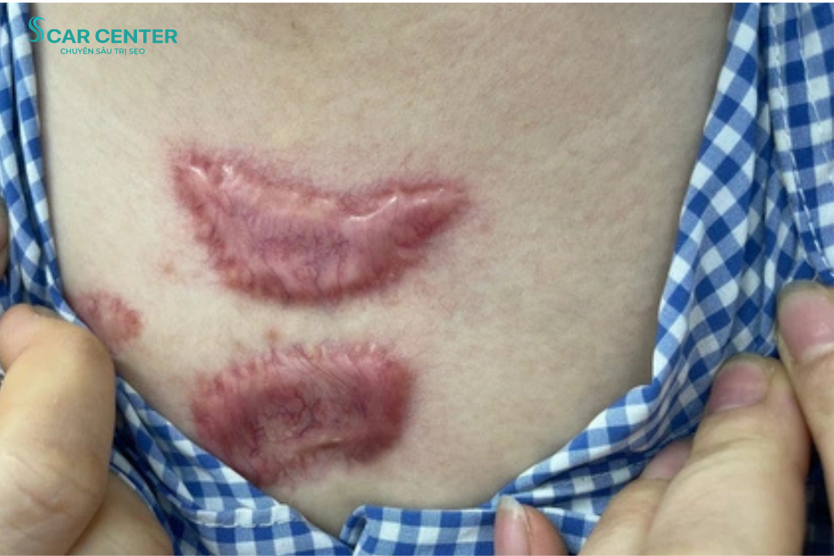Sẹo lồi ngứa và đau do đâu