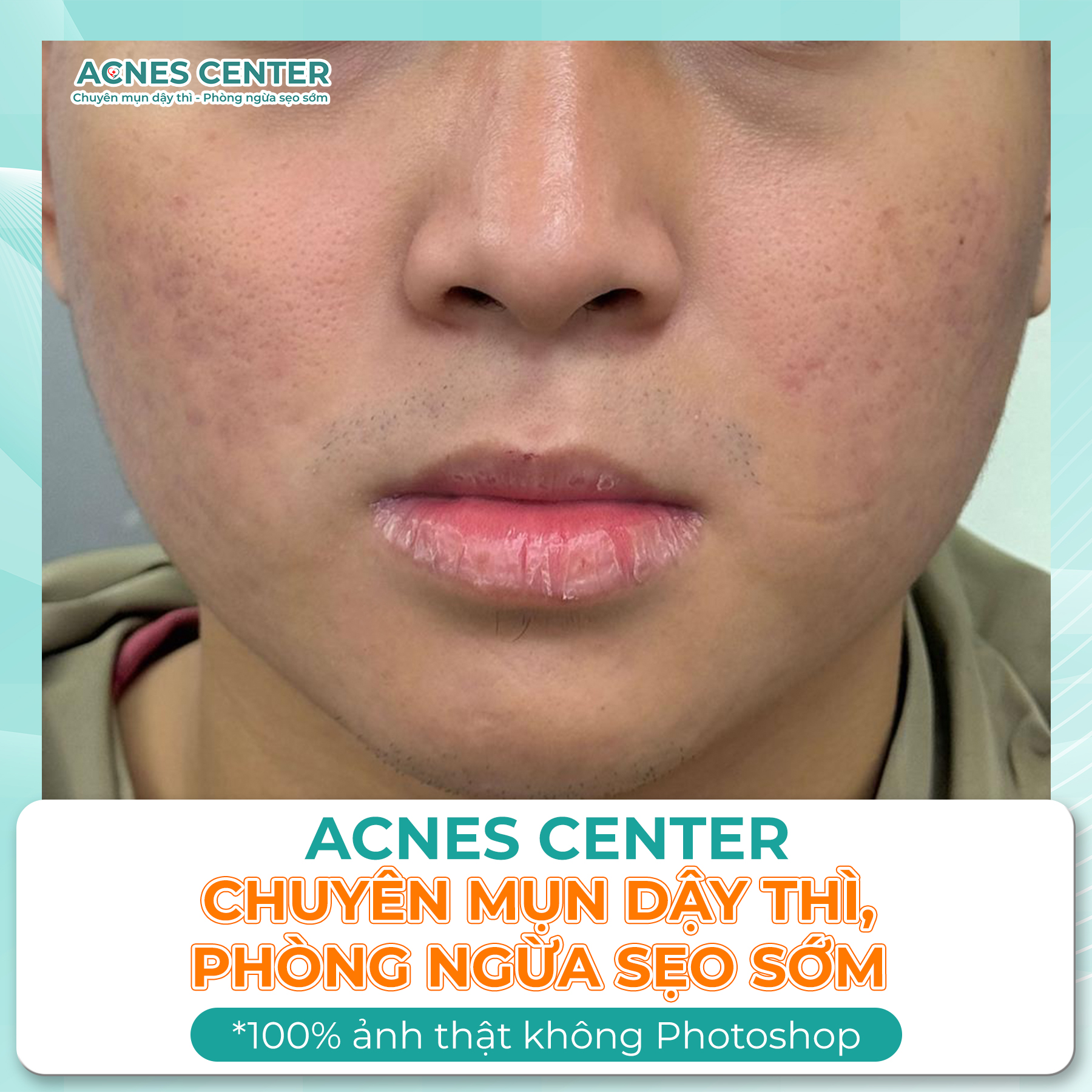 KẾ HOẠCH ĐIỀU TRỊ MỤN TẠI ACNES CENTER CHUẨN Y KHOA