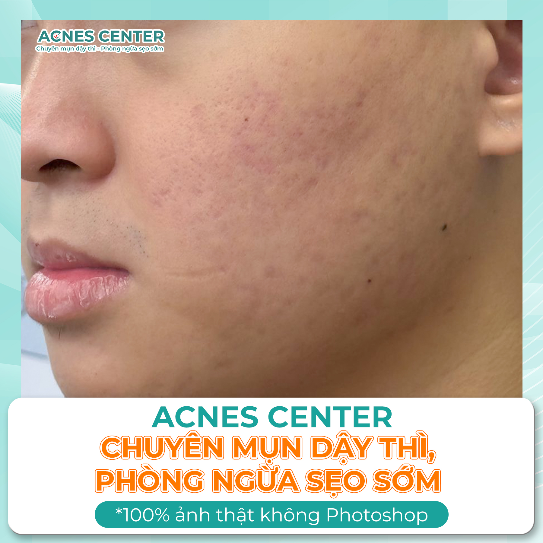 KẾ HOẠCH ĐIỀU TRỊ MỤN TẠI ACNES CENTER CHUẨN Y KHOA