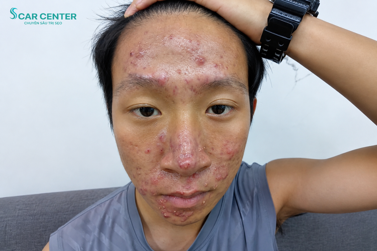 ĐẶNG QUỐC KHÁNH LẤY LẠI SỰ TỰ TIN SAU KHI ĐIỀU TRỊ MỤN TẠI ACNES CENTER