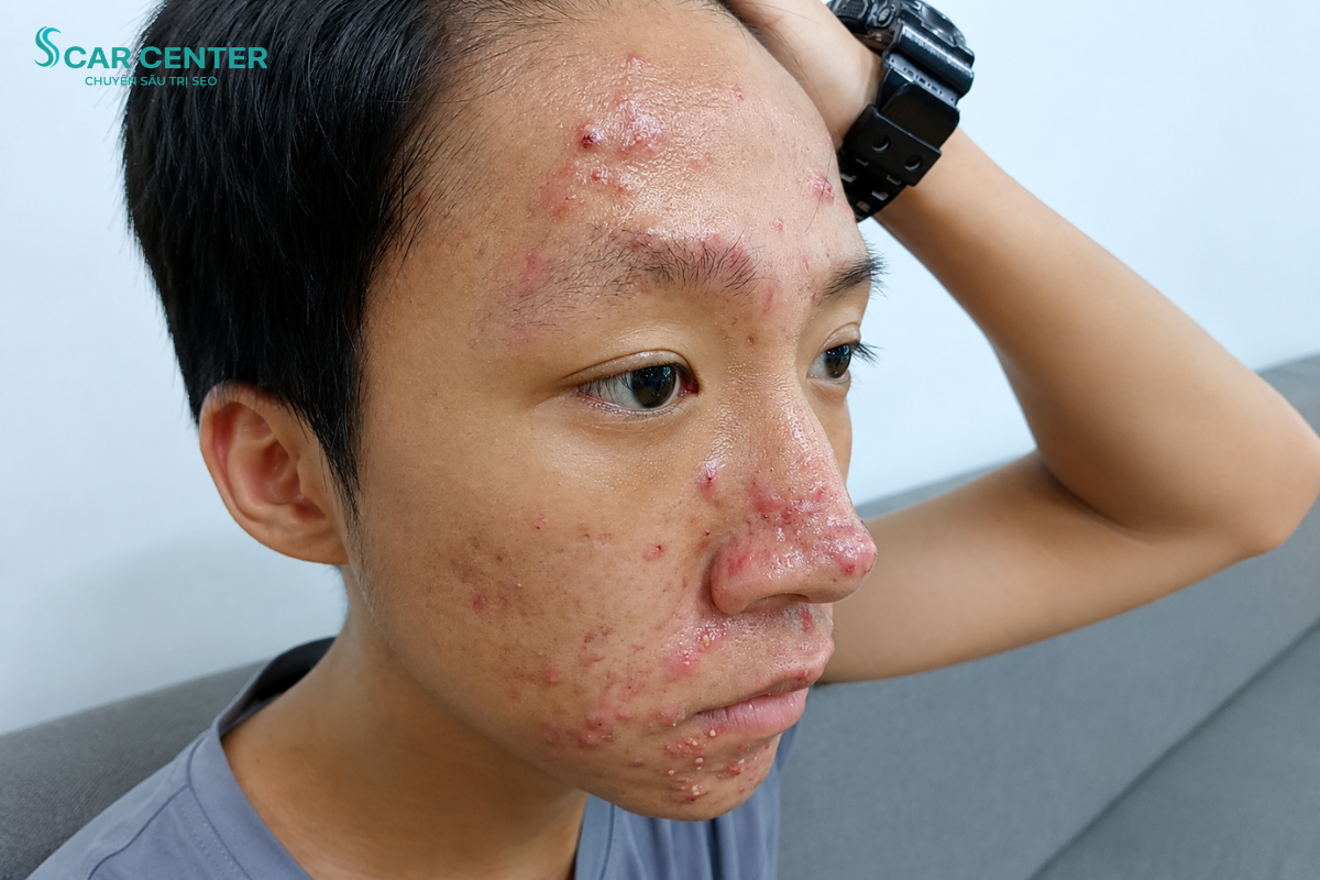 ĐẶNG QUỐC KHÁNH LẤY LẠI SỰ TỰ TIN SAU KHI ĐIỀU TRỊ MỤN TẠI ACNES CENTER