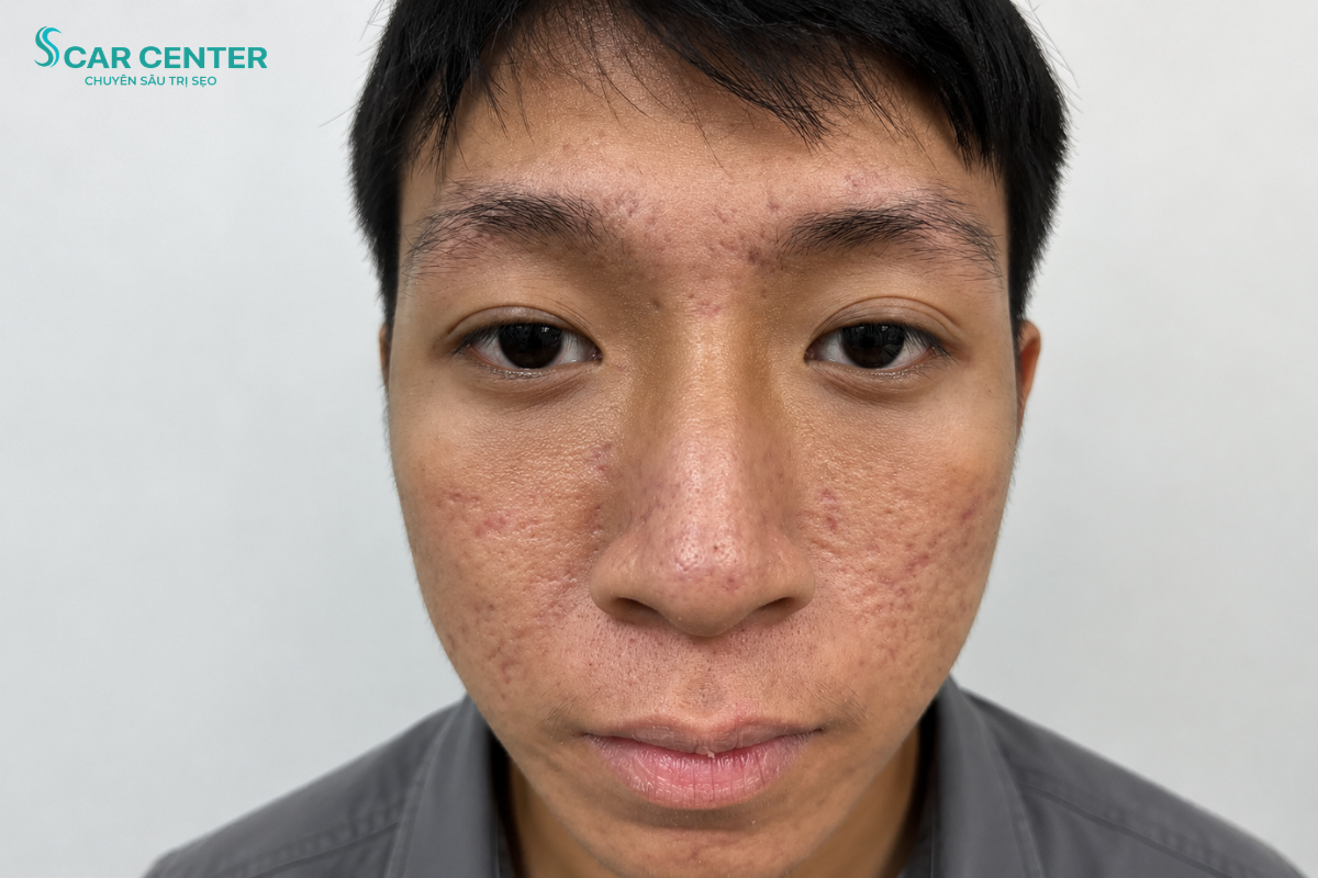 ĐẶNG QUỐC KHÁNH LẤY LẠI SỰ TỰ TIN SAU KHI ĐIỀU TRỊ MỤN TẠI ACNES CENTER