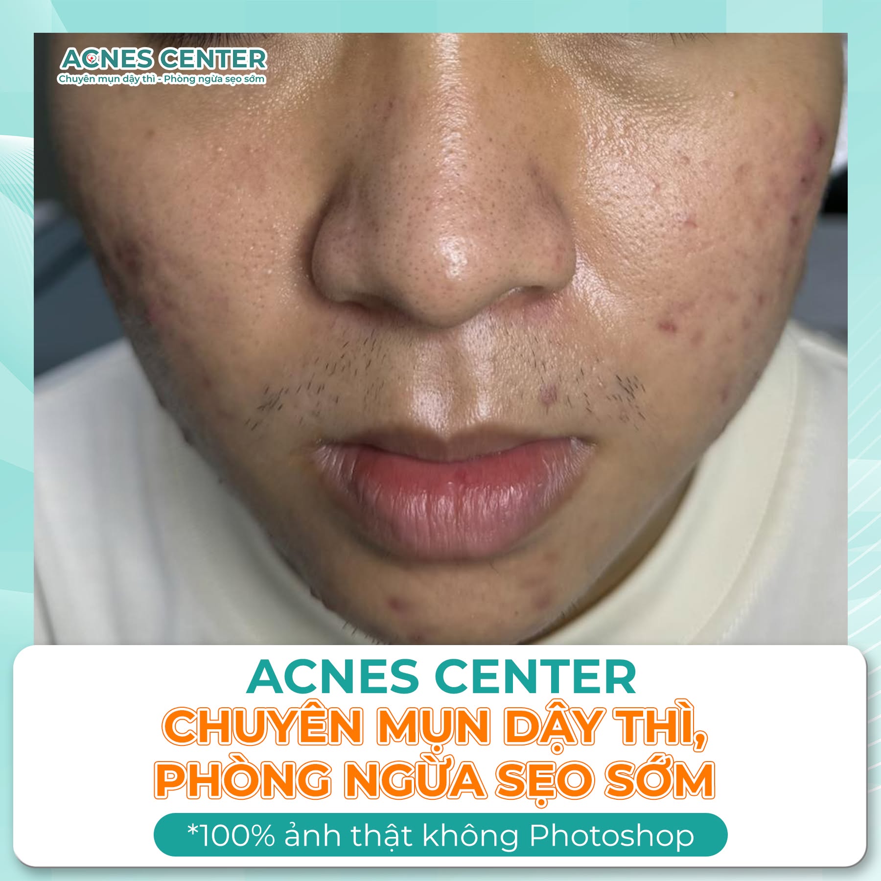 Hành trình lấy lại sự tự tin của Lê Xuân Khang sau khi thoát khỏi mụn nặng