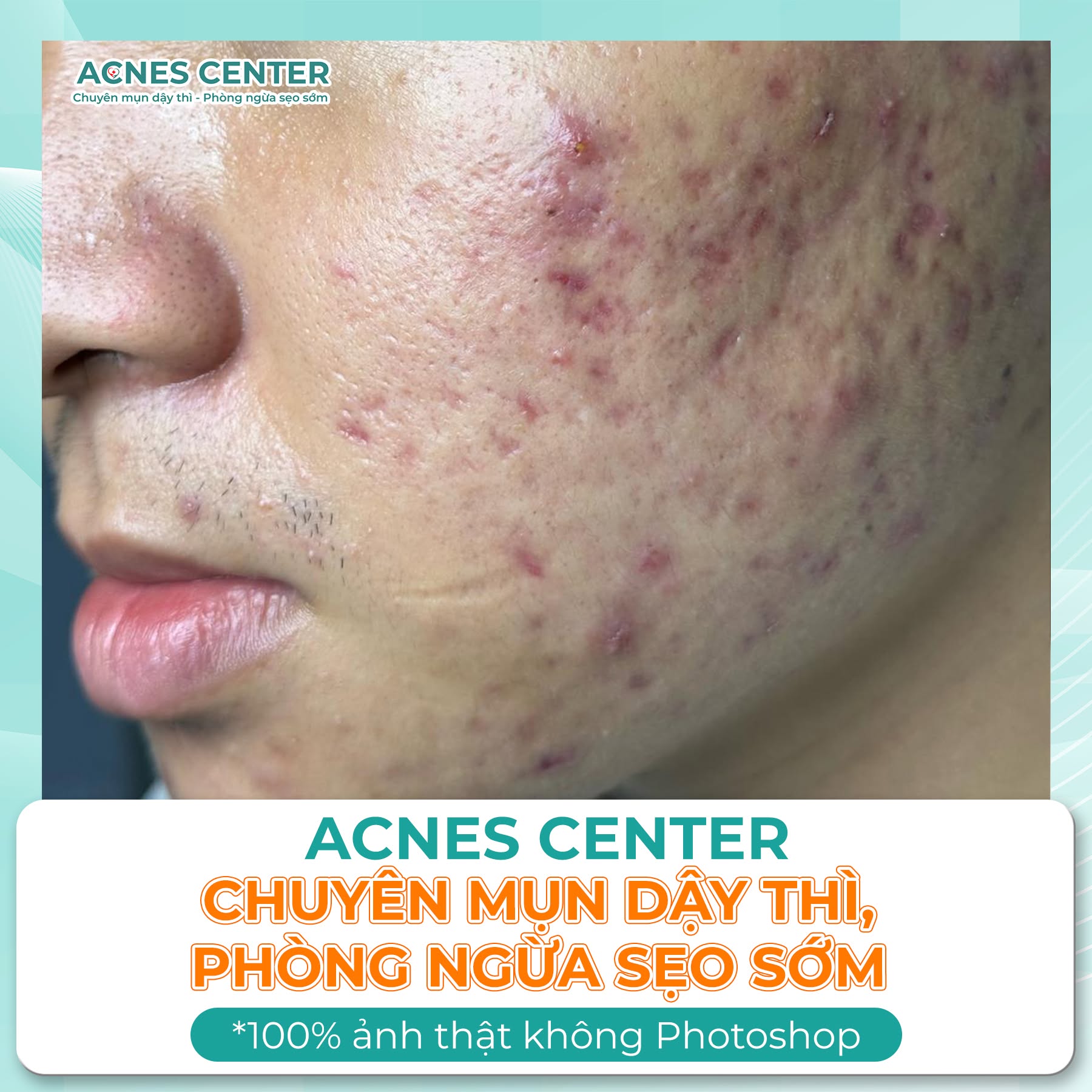 Hành trình lấy lại sự tự tin của Lê Xuân Khang sau khi thoát khỏi mụn nặng