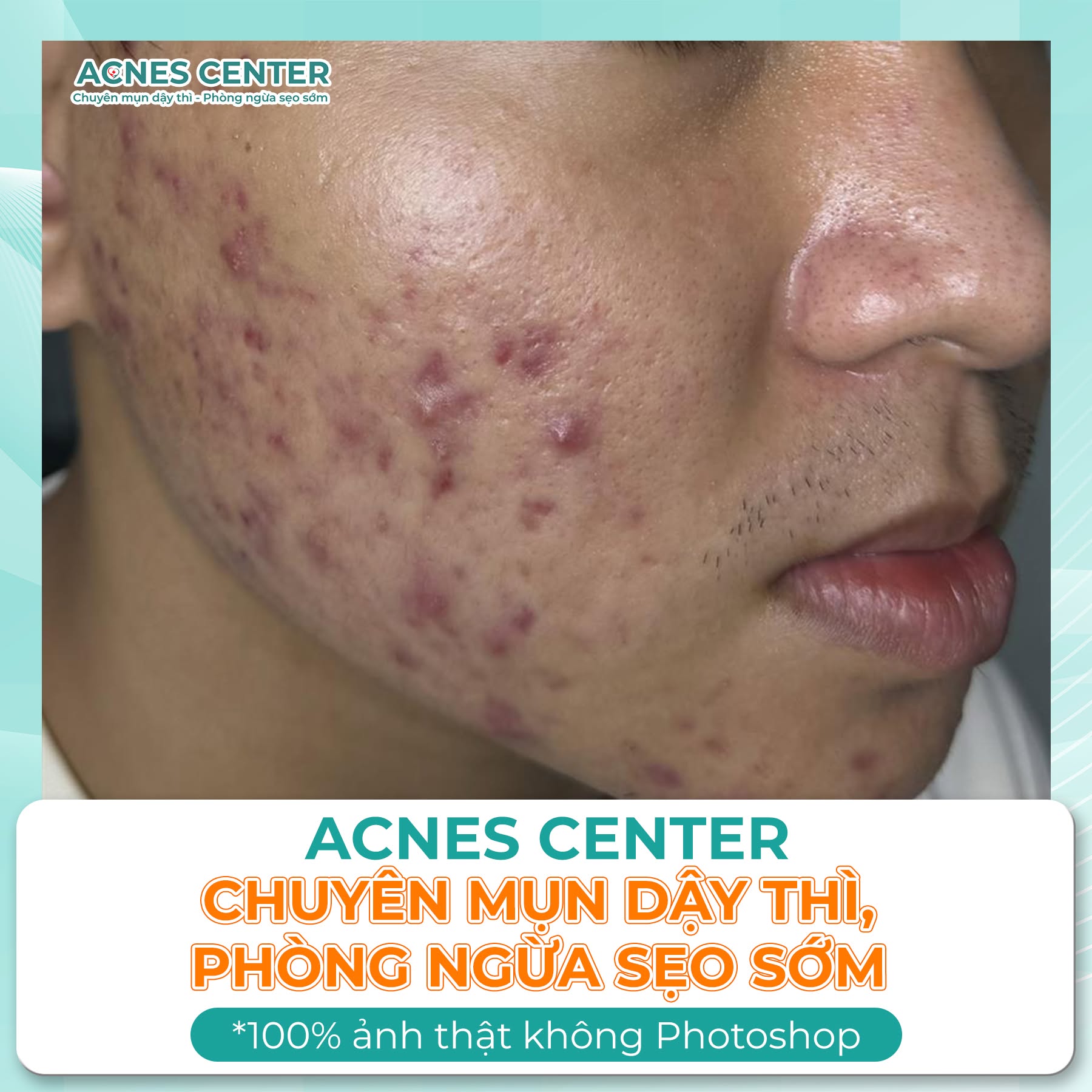 hanh trinh lay lai su tu tin cua le xuan khang sau khi thoat khoi mun nang 5