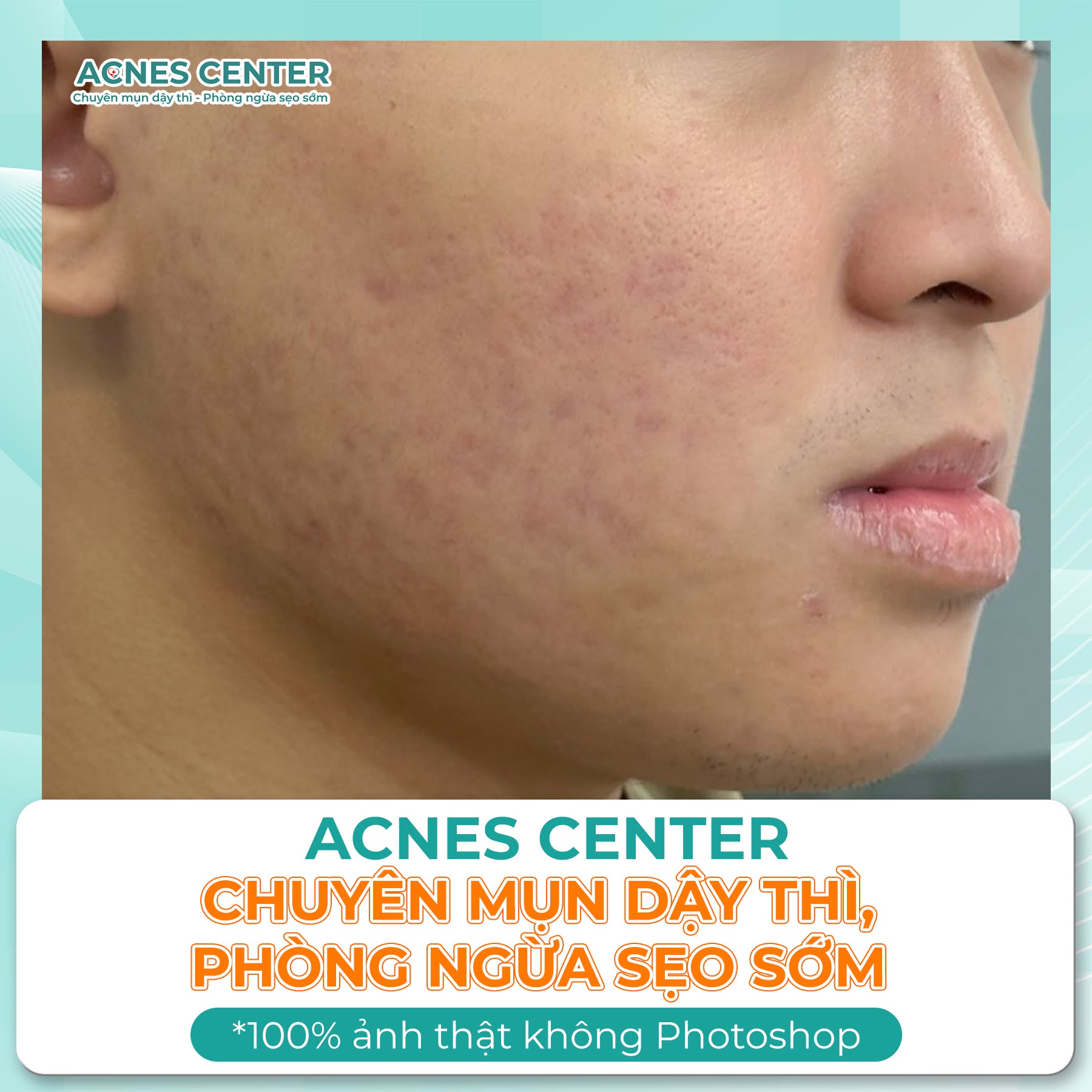 Hành trình lấy lại sự tự tin của Lê Xuân Khang sau khi thoát khỏi mụn nặng