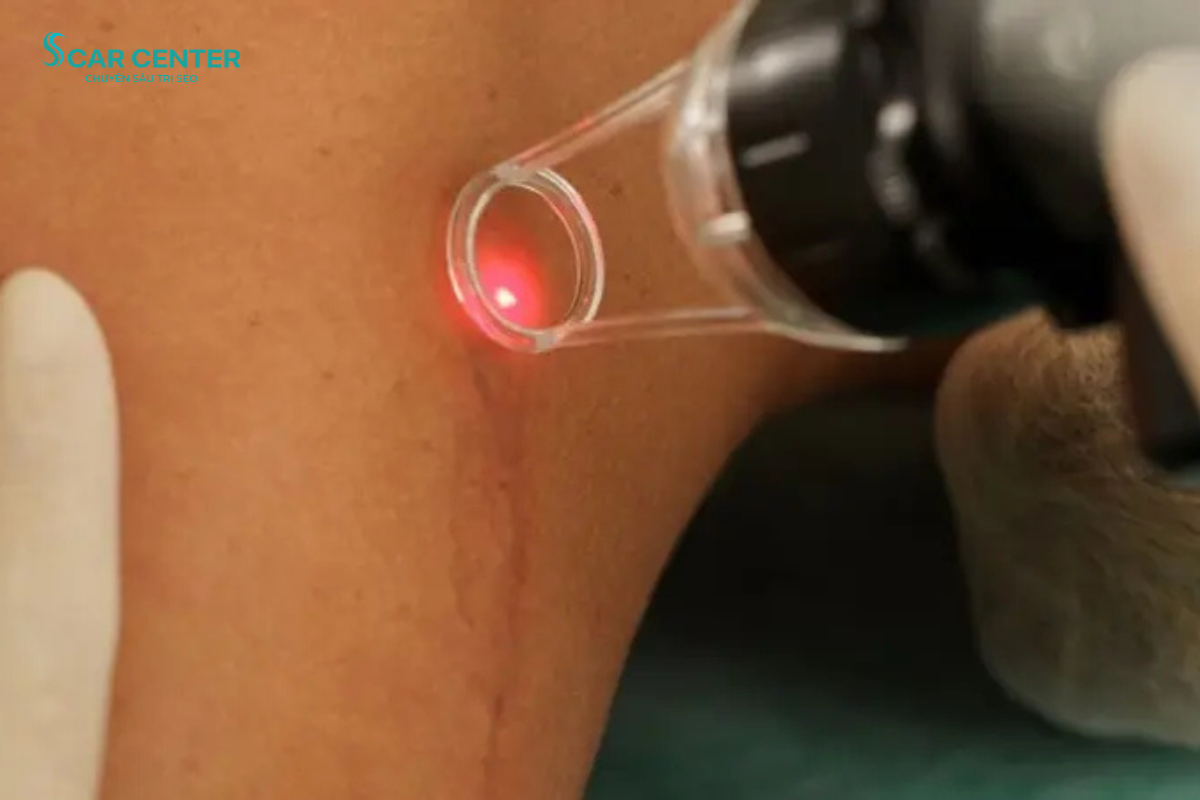 Điều trị sẹo tai nạn bằng Laser: Giải pháp cải thiện sẹo an toàn và hiệu quả