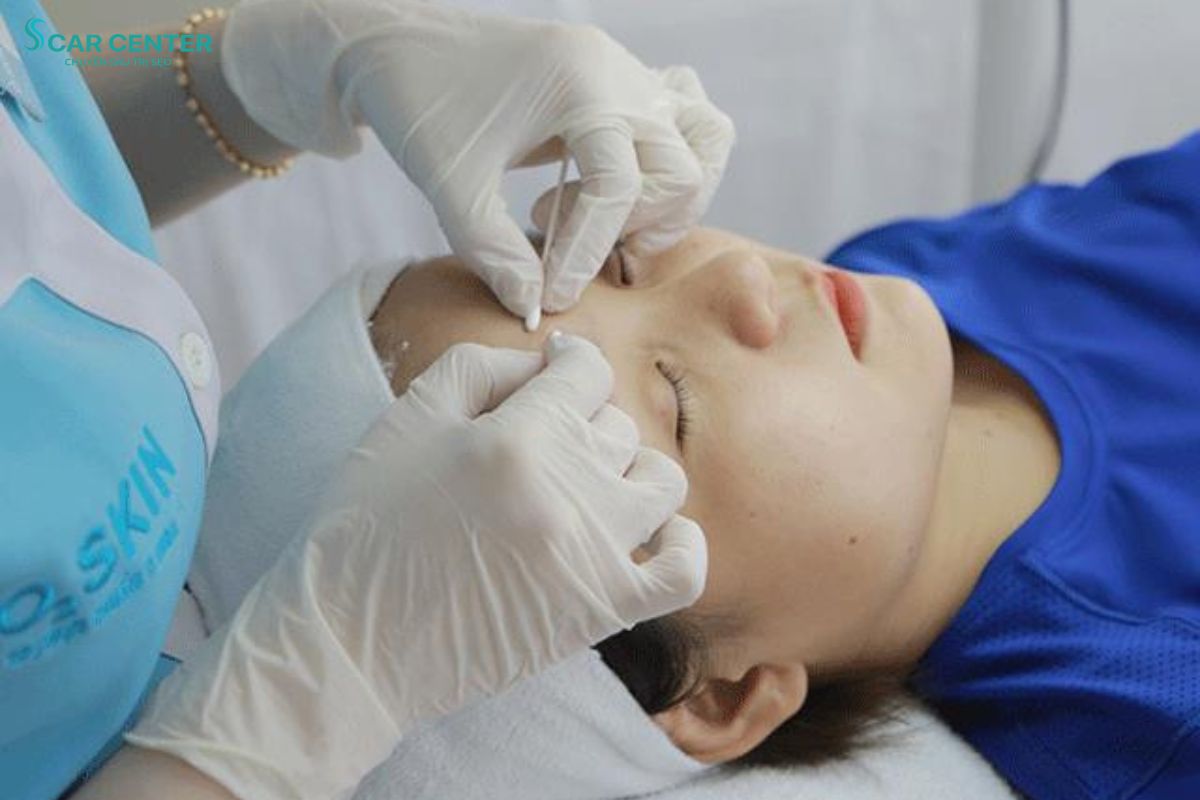 O2 SKIN chuyên tư vấn và điều trị sẹo rỗ theo từng cấp độ