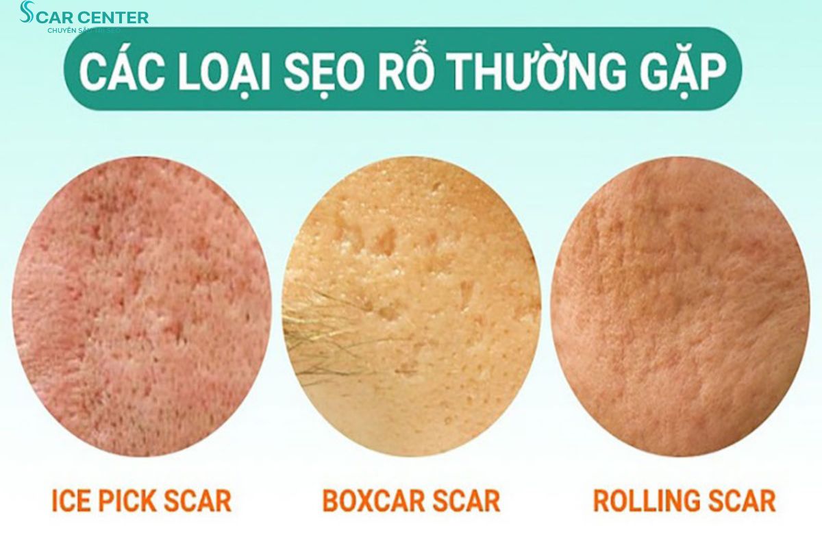Những loại sẹo rỗ thường gặp