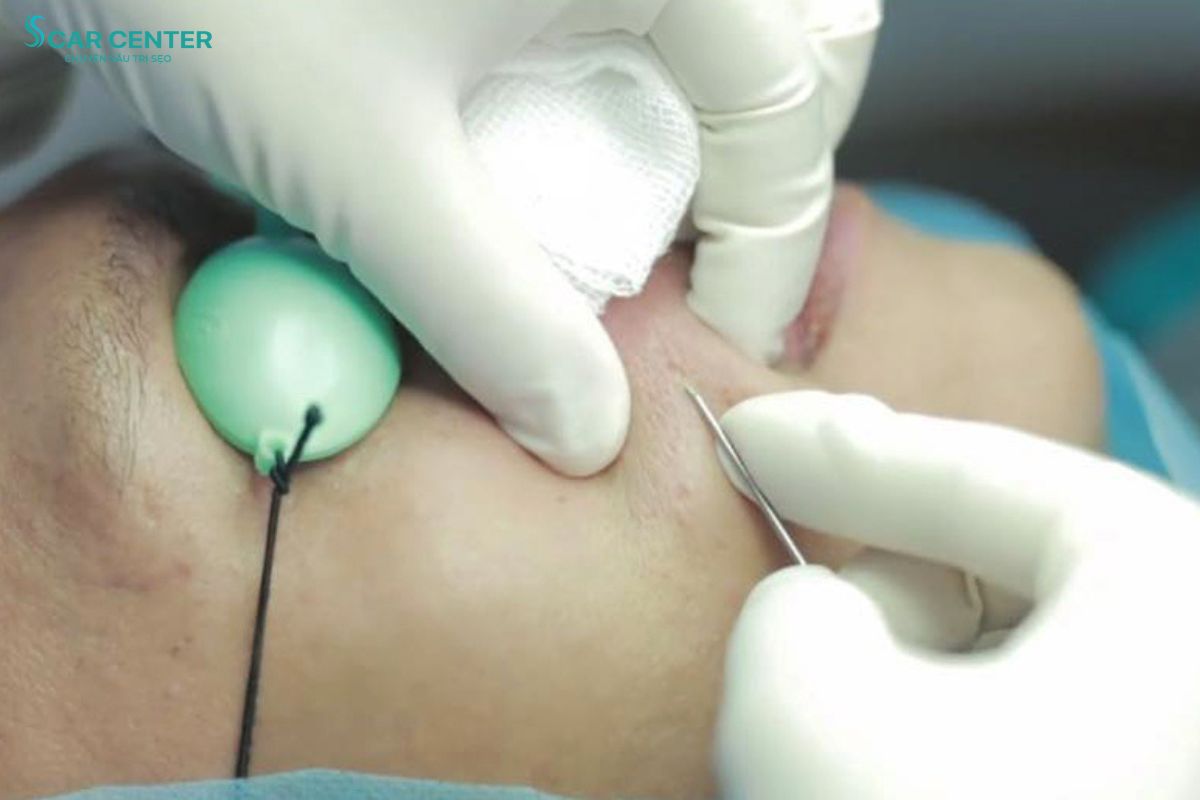 Kỹ thuật bóc tách chân sẹo bằng kim Y khoa