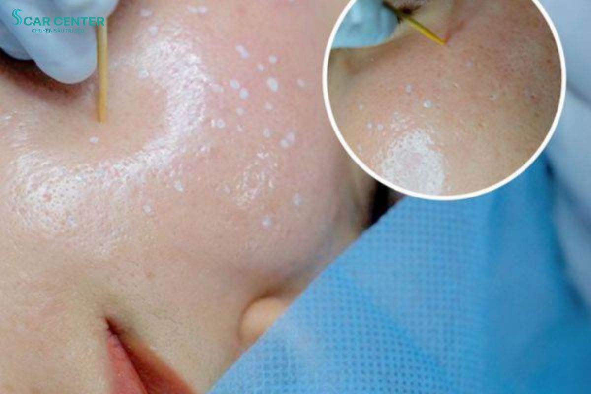 Phương pháp chấm Cross TCA sử dụng acid nồng độ cao tác động chính xác giúp tái tạo đáy sẹo nhọn hiệu quả