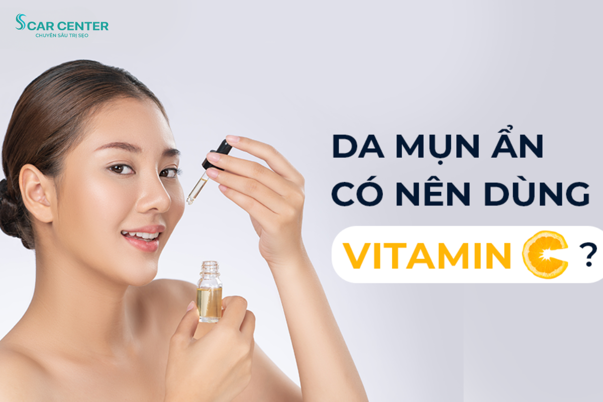 Cách sử dụng Vitamin C cho da mụn hiệu quả